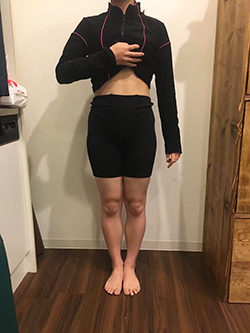 骨盤矯正の施術前